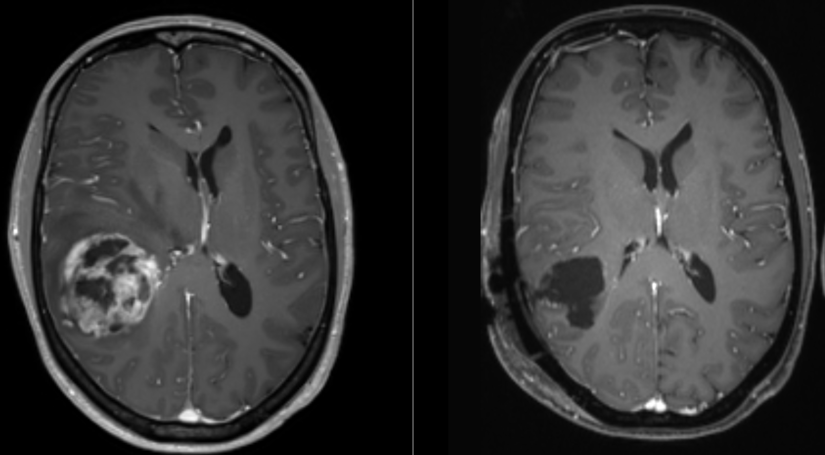 MRI scans showing a glioblastoma before surgery and the surgical cavity after surgery