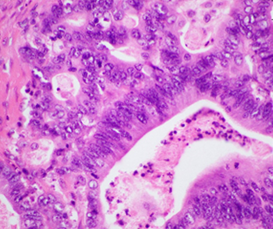 Microscopic histology image of pancreatic ductal adenocarcinoma
