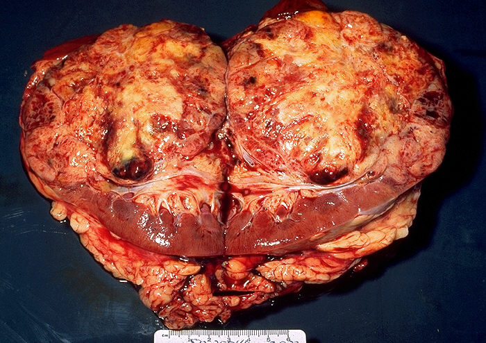 Bisected kidney surgical specimen showing a large renal cell carcinoma